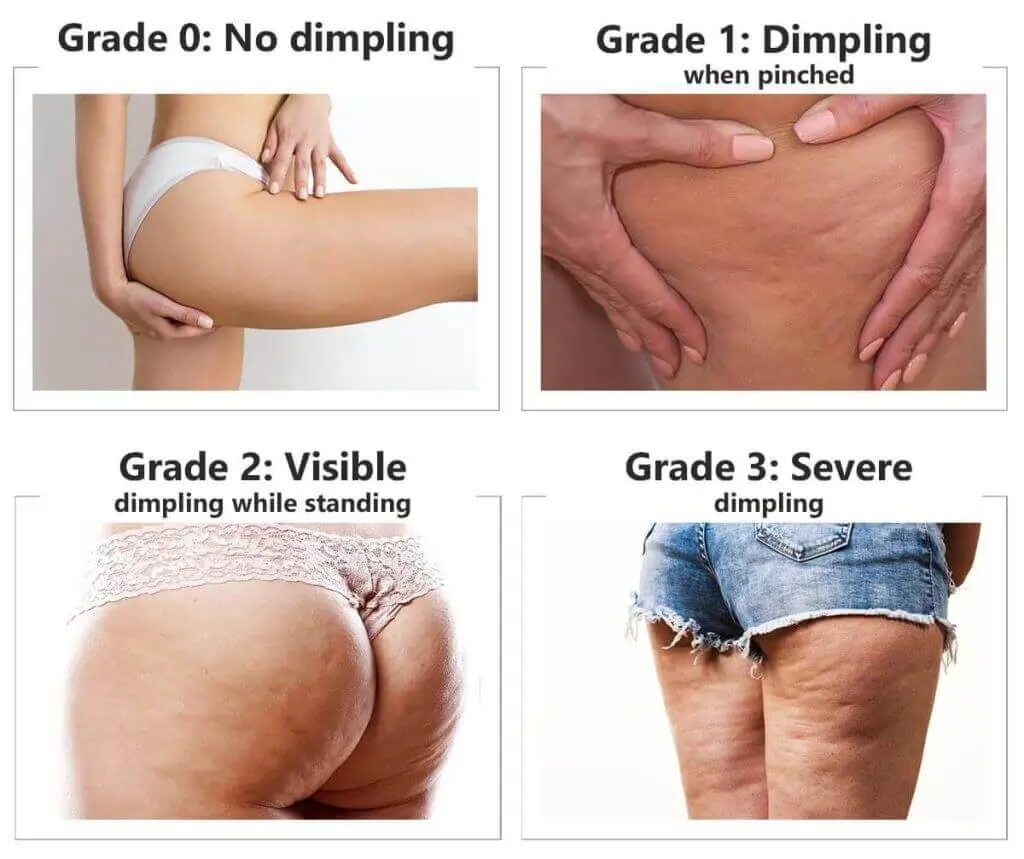 Representation of the stages of cellulite development Ferndown